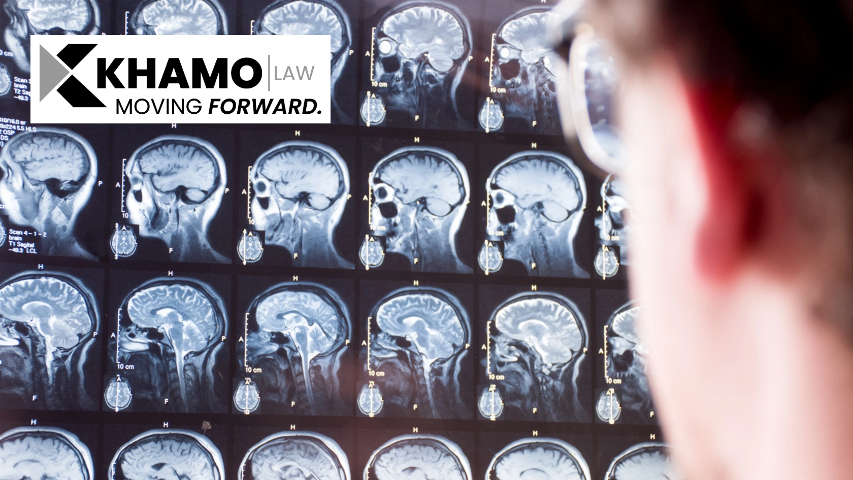 Auto Accident Traumatic Brain Injury Lawyer in Troy MI